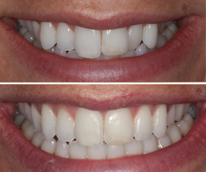 six month smiles