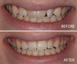 six month smiles