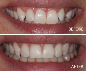 six month smiles