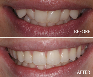 six month smiles