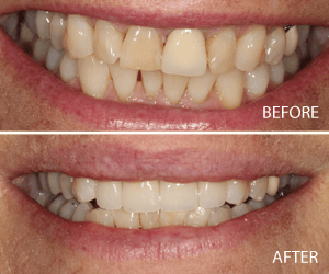 full smile makeover