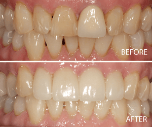 full smile makeover