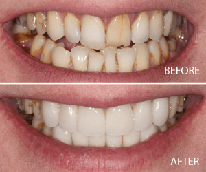 full smile makeover