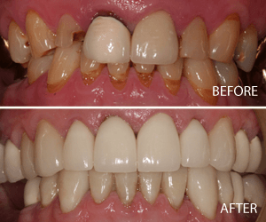 full mouth makeover