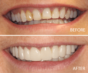 full mouth makeover