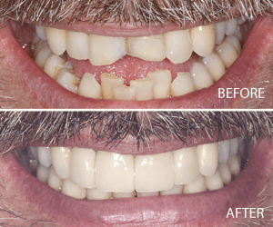 full mouth makeover