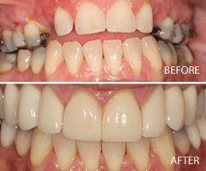 full mouth implant