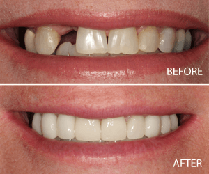 full mouth implant