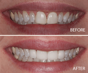 smile makeover