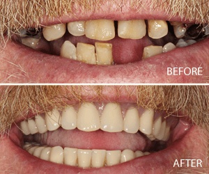 dental implants