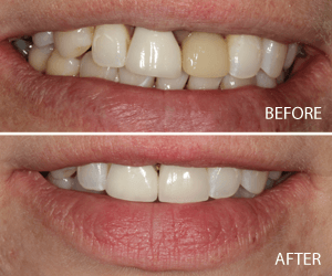 dental implants