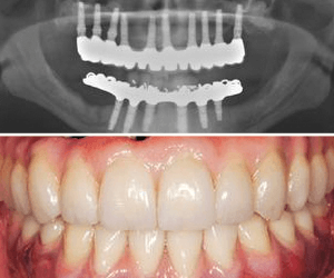 dental implants