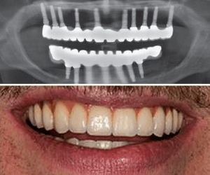 dental implants