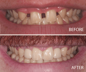 dental implants