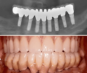 dental implants
