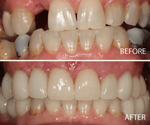 dental implants
