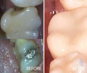 same day crown