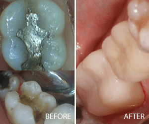 same day crown