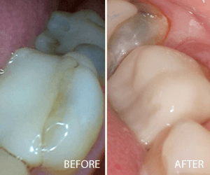 same day crown
