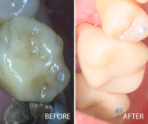 same day crown