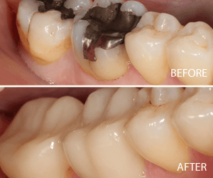 same day crown