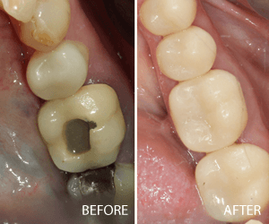 same day crown