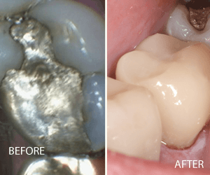 same day crown
