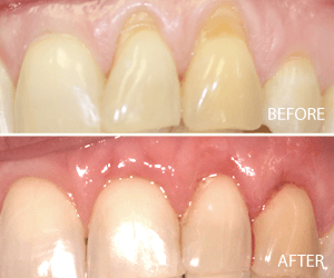 tissue graft