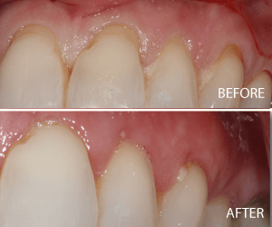 tissue graft