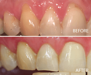 tissue graft