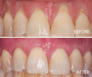 tissue graft