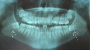 wisdom teeth removal