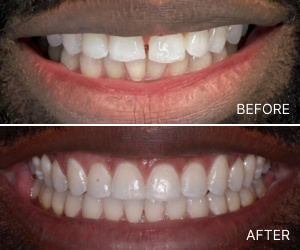smile makeover