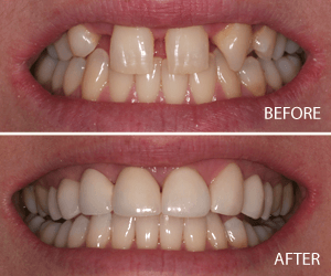 full mouth makeover
