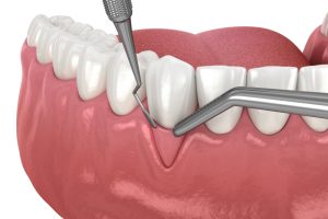 gum graft