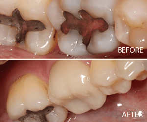same day crown