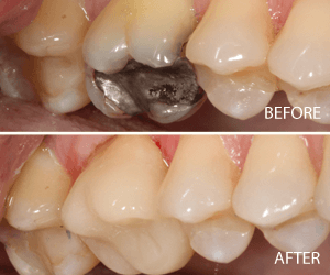 same day crown