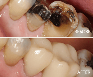 same day crown